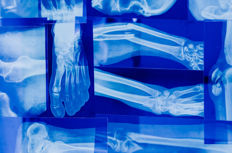 Can a Dog Bite Break a Bone?